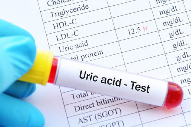 xét nghiệm acid uric